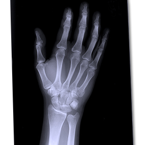 Radiografía de Carpo (mano)